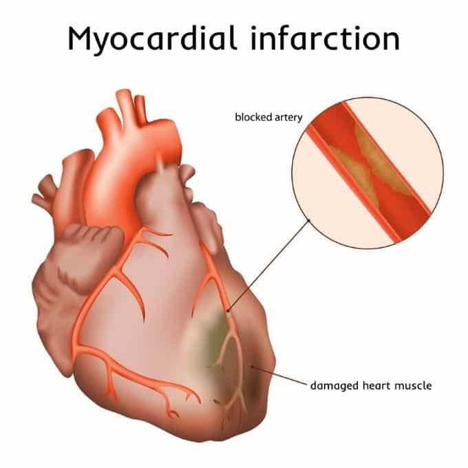 myocardial infarction